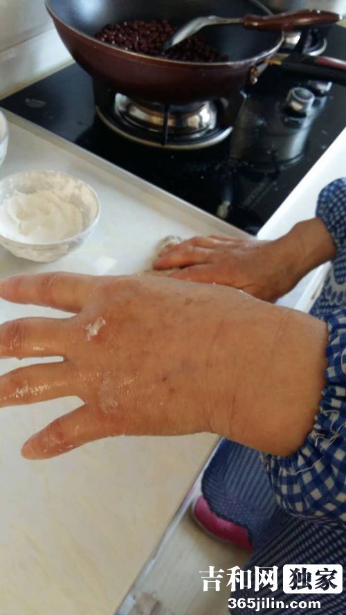 面粉治烫伤是真的吗,面粉能治疗烫伤吗