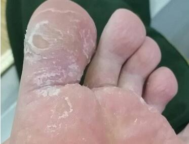 脚底脱皮什么原因怎么办,脚底脱皮什么原因该怎么办
