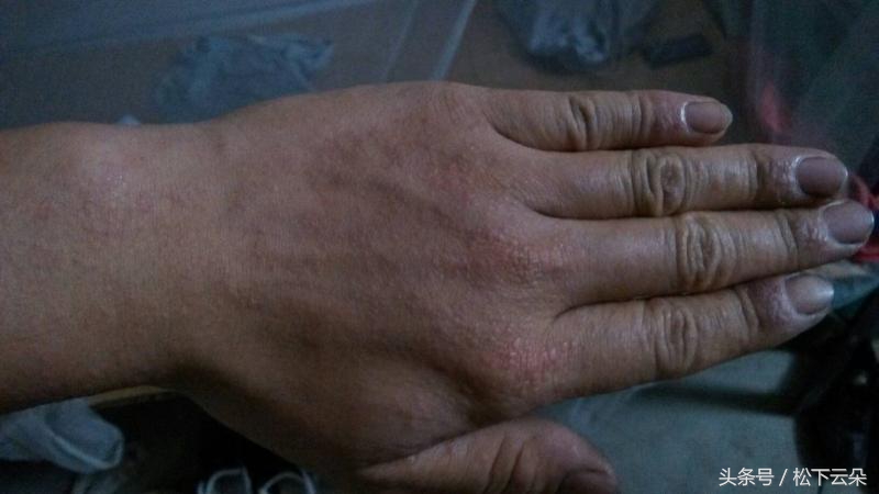 用西瓜皮怎么治痱子,西瓜皮治痱子方法