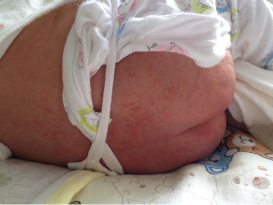 宝宝长痱子可以用痱子粉嘛,宝宝长痱子可以擦痱子粉吗