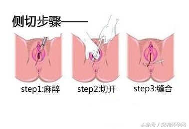 生娃其实没那么痛,顺产侧切的整个过程