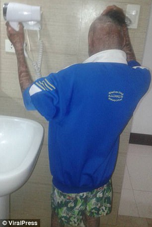 全身被烧伤后的皮肤,皮肤烧伤起皮疹