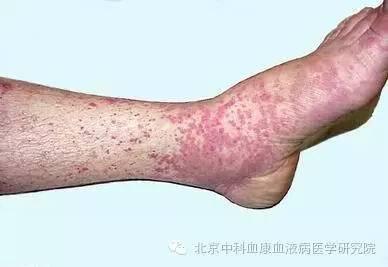儿童过敏性紫癜怎么治疗的短视频,请问有人知道过敏性紫癜吗