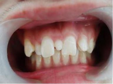 孩子多长了颗牙怎么办？—306医院6.1科普（5）