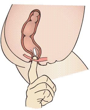 婴儿直肠给药一般多久,宝宝直肠给药有没有危害