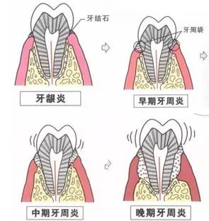 牙周病拖延不治会有什么后果,牙周病拖延有什么后果