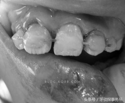 宝宝不谨慎磕到头有事吗,如果乳牙被磕伤了怎么办