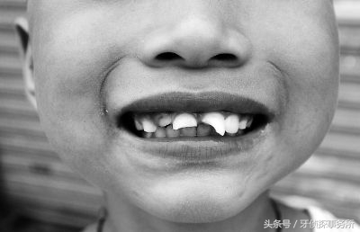 宝宝不谨慎磕到头有事吗,如果乳牙被磕伤了怎么办