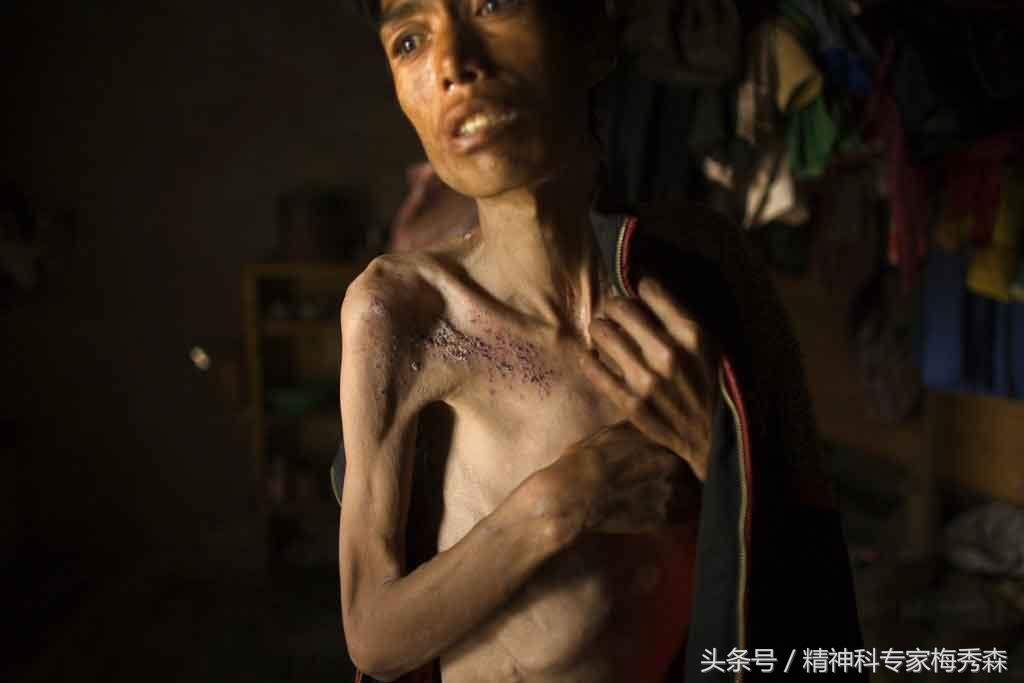 戒毒生理上会难受几天,戒毒身体会发生什么