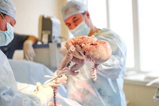 直击剖腹产全过程，看一次震撼一次心灵各位宝爸请珍惜