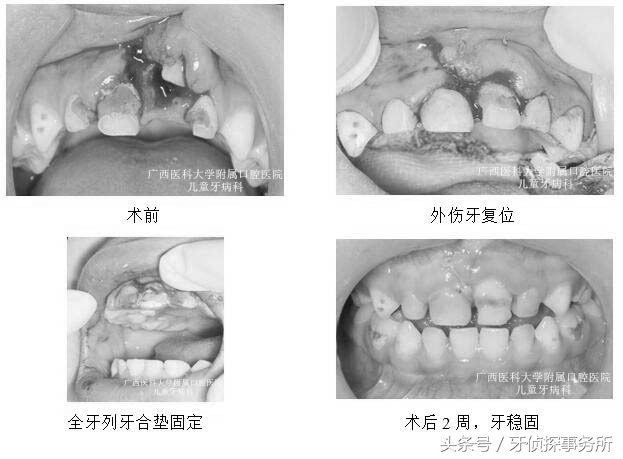 宝宝不谨慎磕到头有事吗,如果乳牙被磕伤了怎么办