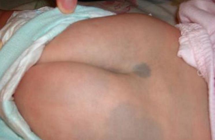 婴儿身上有痣和胎记,婴儿胎记和痣怎么区分