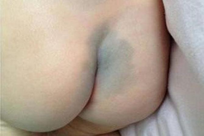 婴儿身上有痣和胎记,婴儿胎记和痣怎么区分