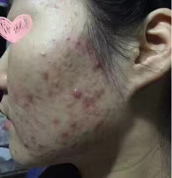 如何预防长痘和祛痘,怎么防止闷痘变脓痘