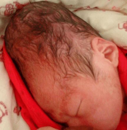 新生儿头上突然起个软包照片,新生儿头发现一个包