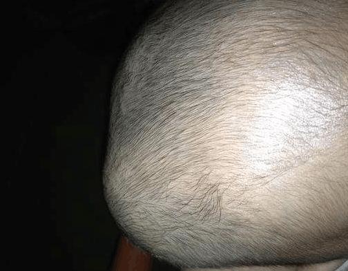 新生儿头上突然起个软包照片,新生儿头发现一个包