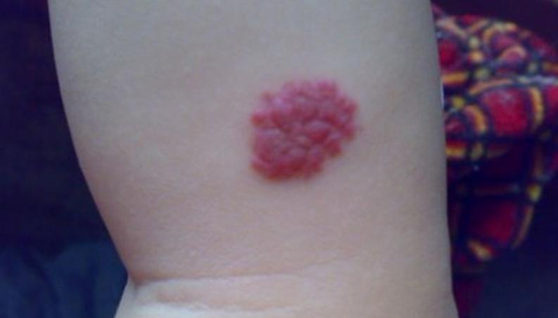 婴儿身上有痣和胎记,婴儿胎记和痣怎么区分