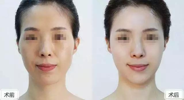 太阳穴凹陷的女人怎么破解,太阳穴凹陷的小妙招