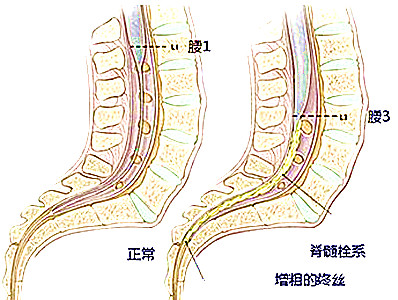 脊髓栓系皮肤症状图片,脊髓栓系早期症状会尿频吗