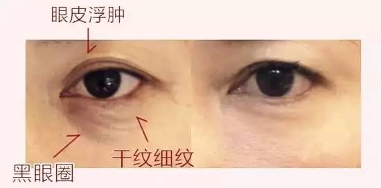 激光去眼袋恢复过程照片,激光去眼袋最真实的经历