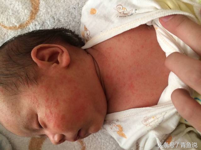颈部有红疹子用什么药好得快,婴儿颈部红斑是怎么回事