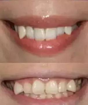 霓虹人民牙齿烂，居然引起了国际讨论背后原因才是父母该重视的