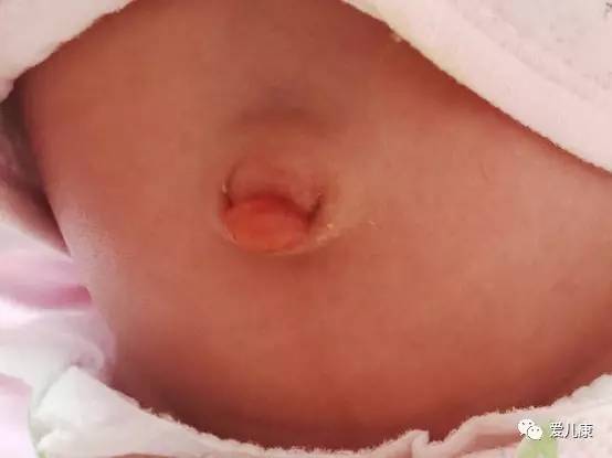宝宝肚脐长肉芽是怎么回事,新生儿肚脐有肉芽需要手术么