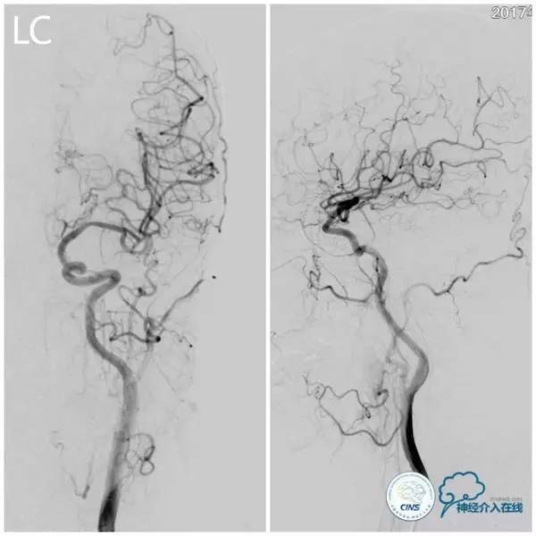 天坛周记,天坛医院脑动脉狭窄