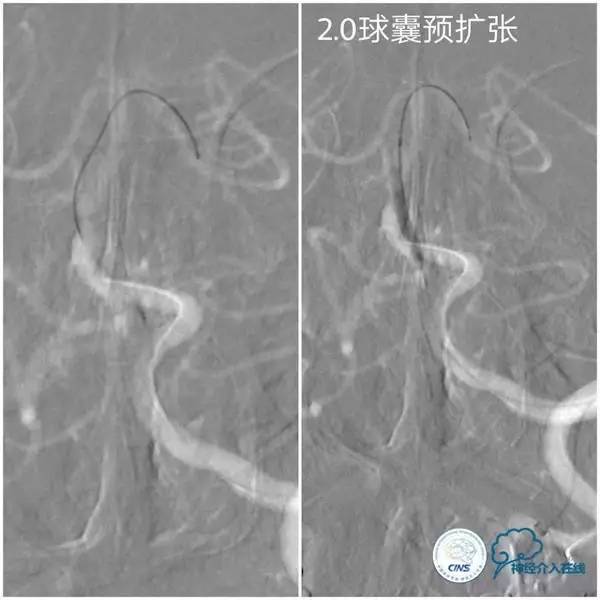 天坛周记,天坛医院脑动脉狭窄