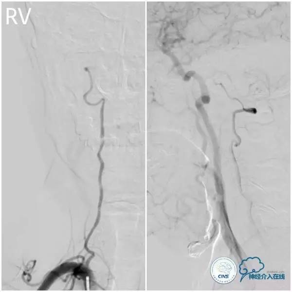 天坛周记,天坛医院脑动脉狭窄