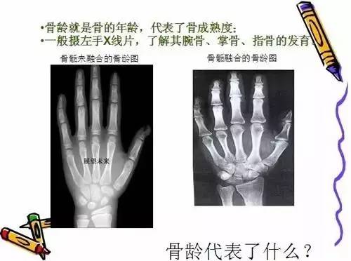 骨龄意义,骨龄有没有实际意义