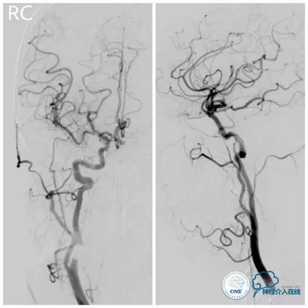 天坛周记,天坛医院脑动脉狭窄