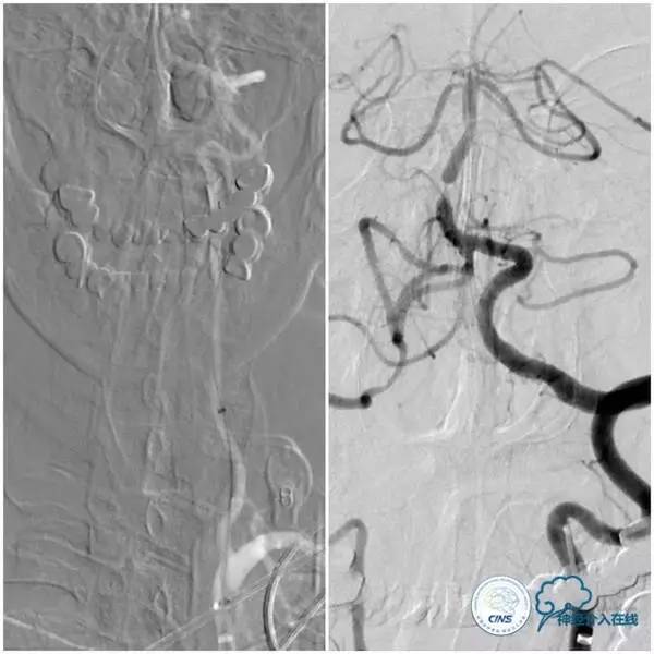 天坛周记,天坛医院脑动脉狭窄
