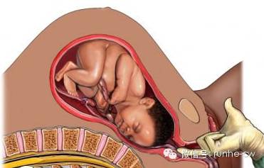 胎儿命悬一线医生托举24分钟救命,怀孕6个月医生跪地救人