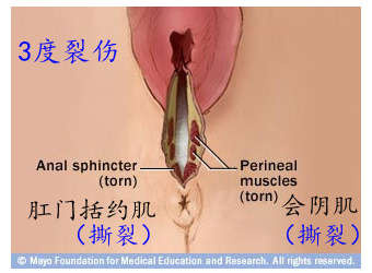 顺产为什么侧切的多,顺产为什么要外阴侧切