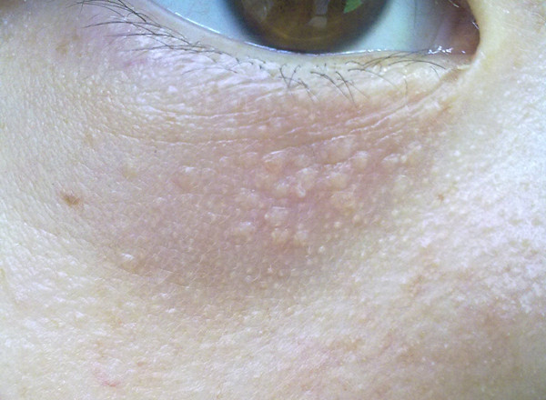 脂肪粒用什么方法能让它消除,眼部脂肪粒消除最快方法