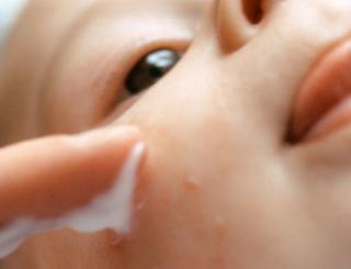 神经性皮炎能吃芒果吗,芒果会加重皮炎吗