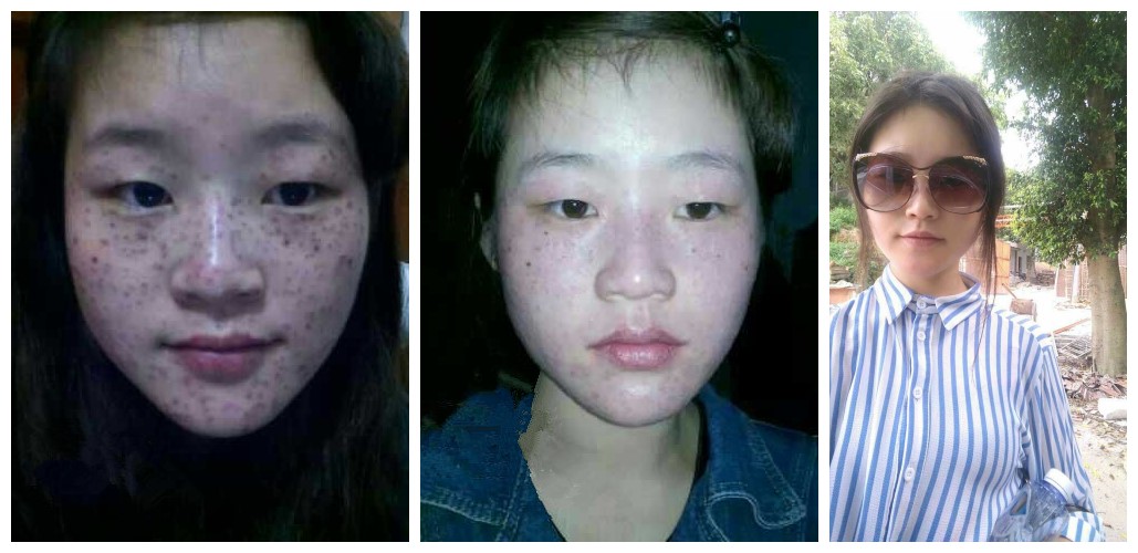 不花钱就能祛斑,不花钱有没有祛斑的方法