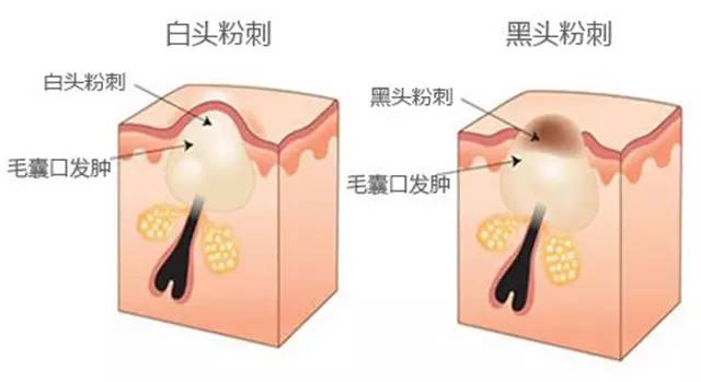 丘疹痘痘的症状和原因,青春期痘痘的症状和治疗方法