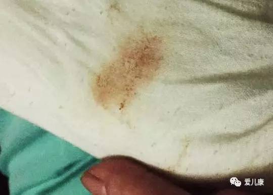 专家在线丨宝宝吐奶为何是红褐色的？婴幼儿反复发烧该怎么办？流鼻涕可以接种疫苗吗？