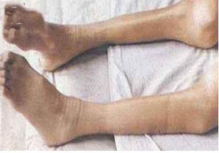 股骨头坏死肌肉萎缩能恢复正常吗,股骨头坏死肌肉萎缩能自愈吗