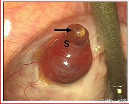 排卵期怀孕了有什么特别症状表现,女人排卵期有什么明显表现