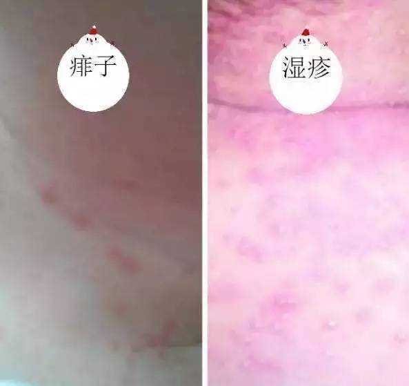 大人痱子一招轻松搞定,夏天痱子湿疹一招搞定