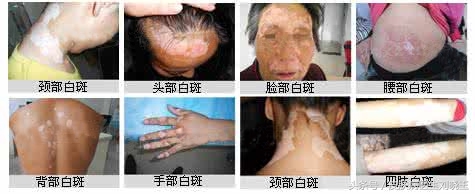 白癜风早期可以吃白癜风胶囊吗,白癜风怎么才能知道已经治好了