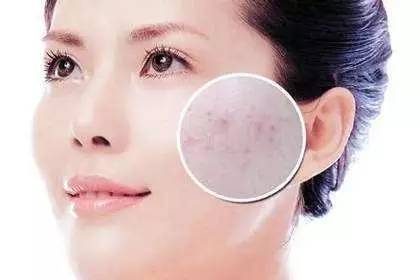 怎么祛痘印最好最快最有效,祛痘印祛斑的最有效的护肤品