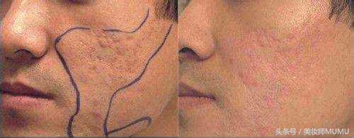痘坑等于毁容！能修复得好吗？