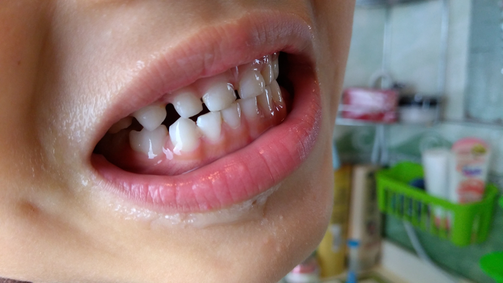 小孩牙齿蛀牙补牙好不好,幼儿牙齿蛀牙是否需要补