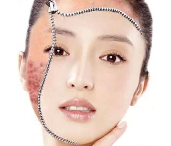 得了激素脸怎么办,排激素脸祛痘发现痘痘更加严重了