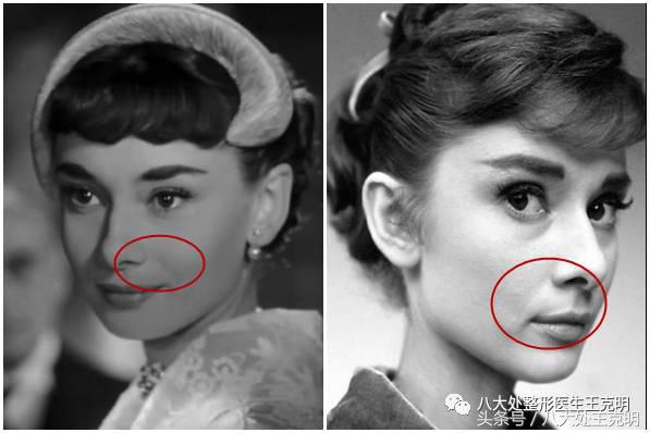 杨紫的法令纹能消除吗,杨紫法令纹很深怎么回事