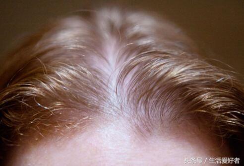 超有效的生发防脱发技巧,脱发怎么办四个有效生发方法